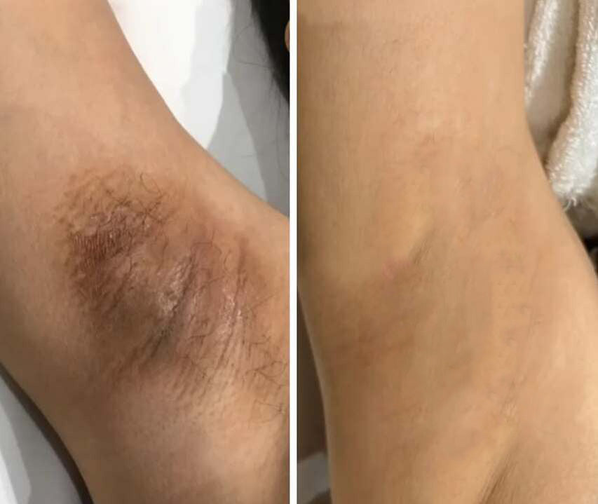 MÁSCARA DESPÍDETE DE LAS MANCHAS - PARAWO