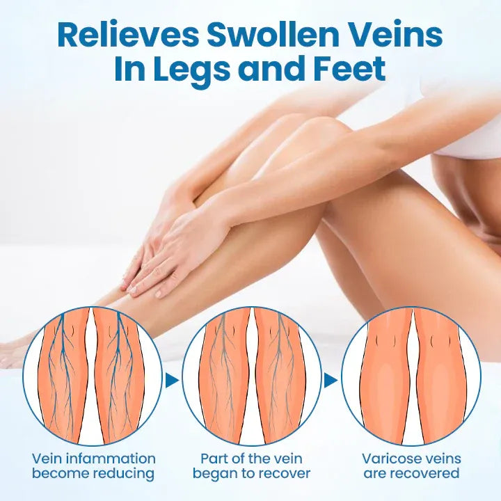 SPRAY ELIMINADOR DE VENAS VARICOSAS EN SOLO 7 DÍAS